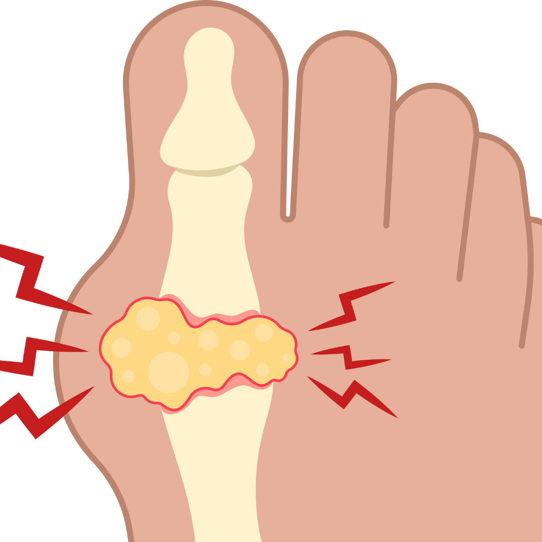 URIC ACID - Causes, Symptoms & Treatments with Herbal, Ayurvedic Supplements for Arthritis, Sciatica, and Pain Relief
