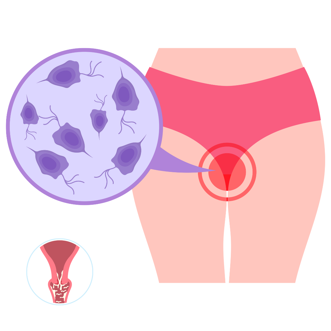 VAGINAL INFECTION  - Causes, Symptoms & Treatments with  Herbal |  Ayurvedic | Supplements