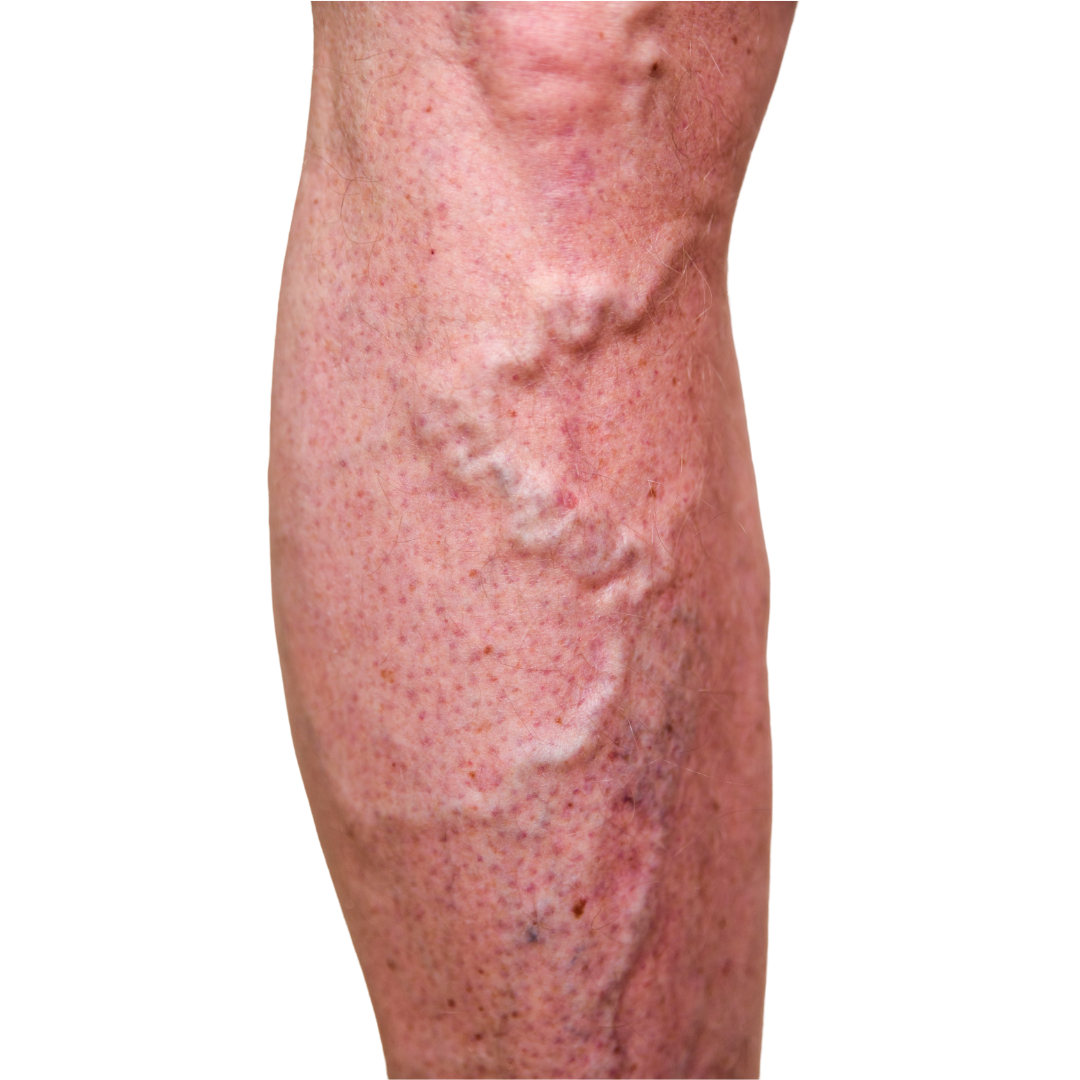 VARICOSE VEINS  - Causes, Symptoms & Treatments with  Herbal |  Ayurvedic | Supplements