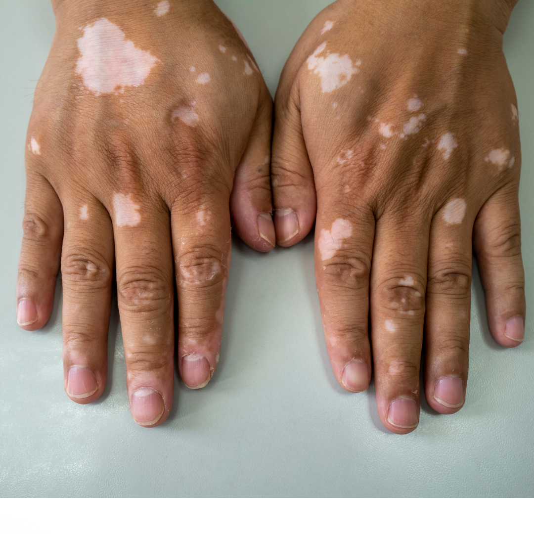 vitiligo treatment