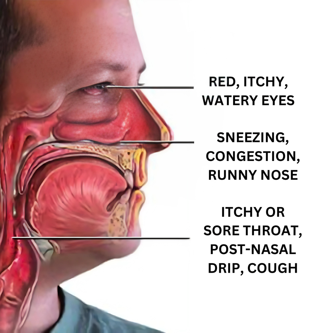 Allergic Rhintis : Causes, Symptoms & Treatments with  Herbal |  Ayurvedic | Supplements