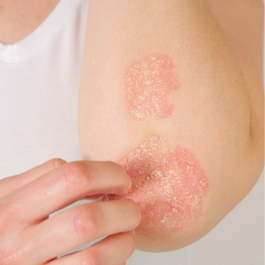 ECZEMA  - Causes, Symptoms & Treatments with  Herbal |  Ayurvedic | Supplements