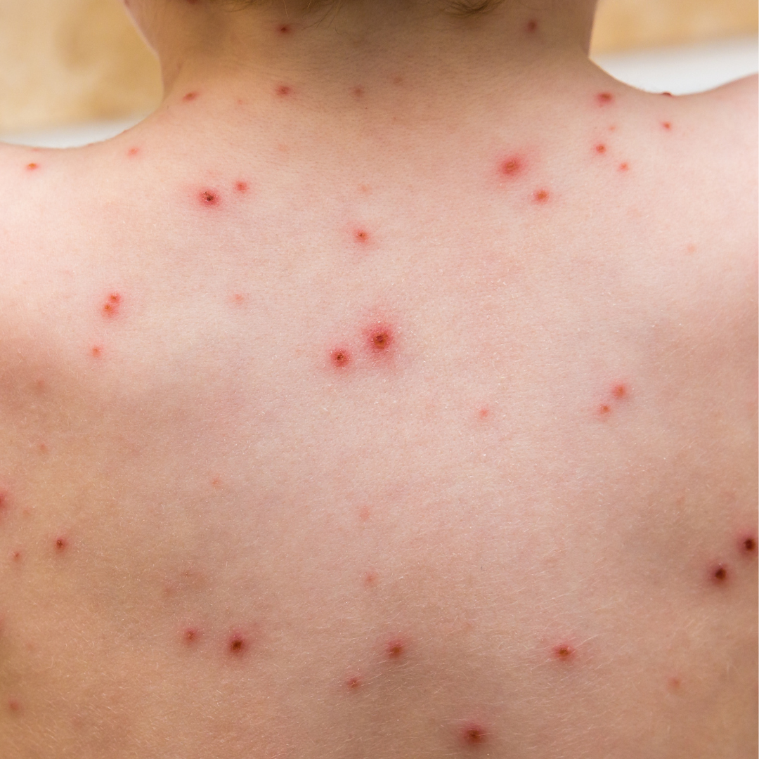 CHICKEN POX  - Causes, Symptoms & Treatments with  Herbal |  Ayurvedic | Supplements