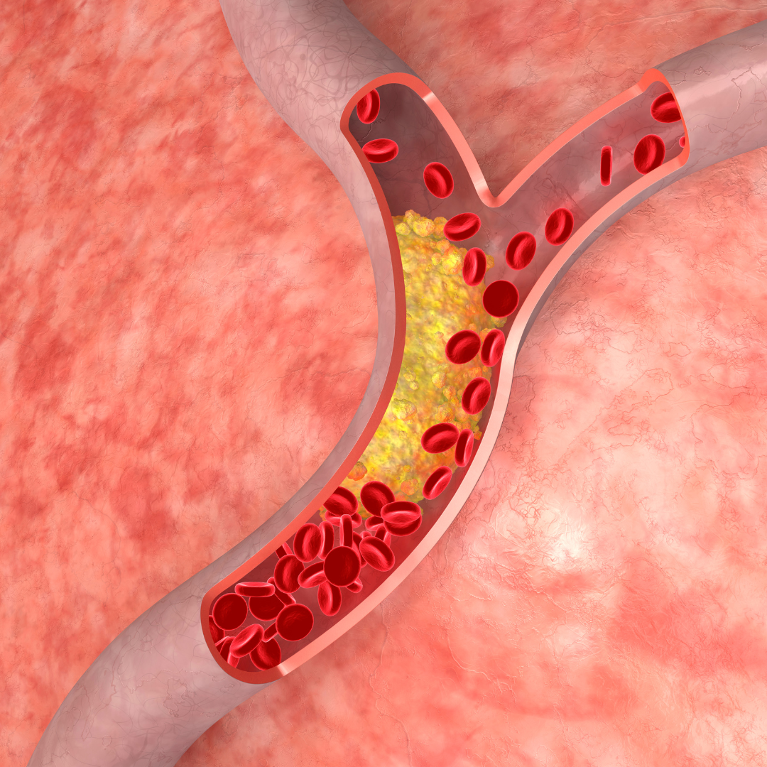 CHOLESTEROL - Causes, Symptoms & Treatments with  Herbal |  Ayurvedic | Supplements