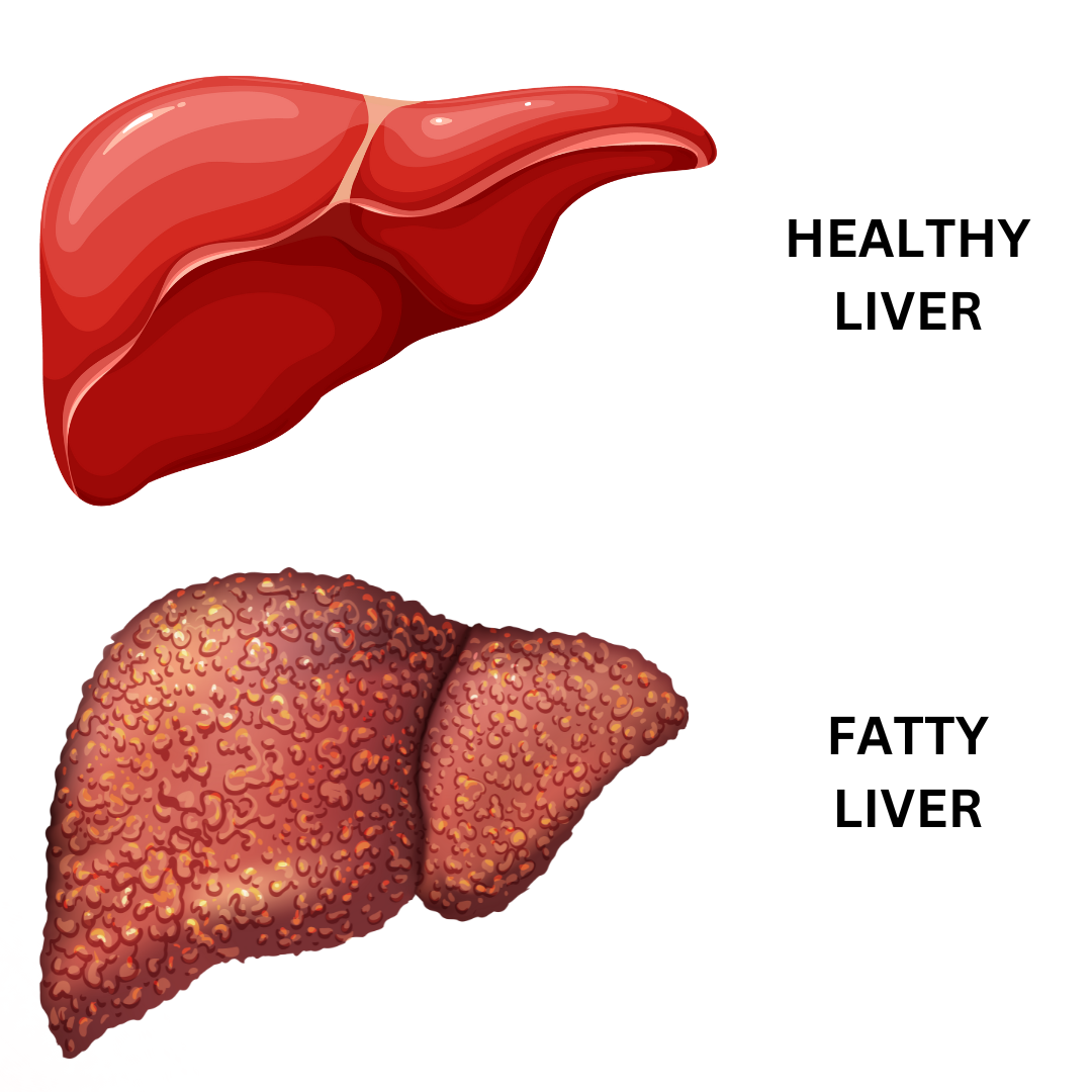 FATTY LIVER - Causes, Symptoms & Treatments with  Herbal |  Ayurvedic | Supplements