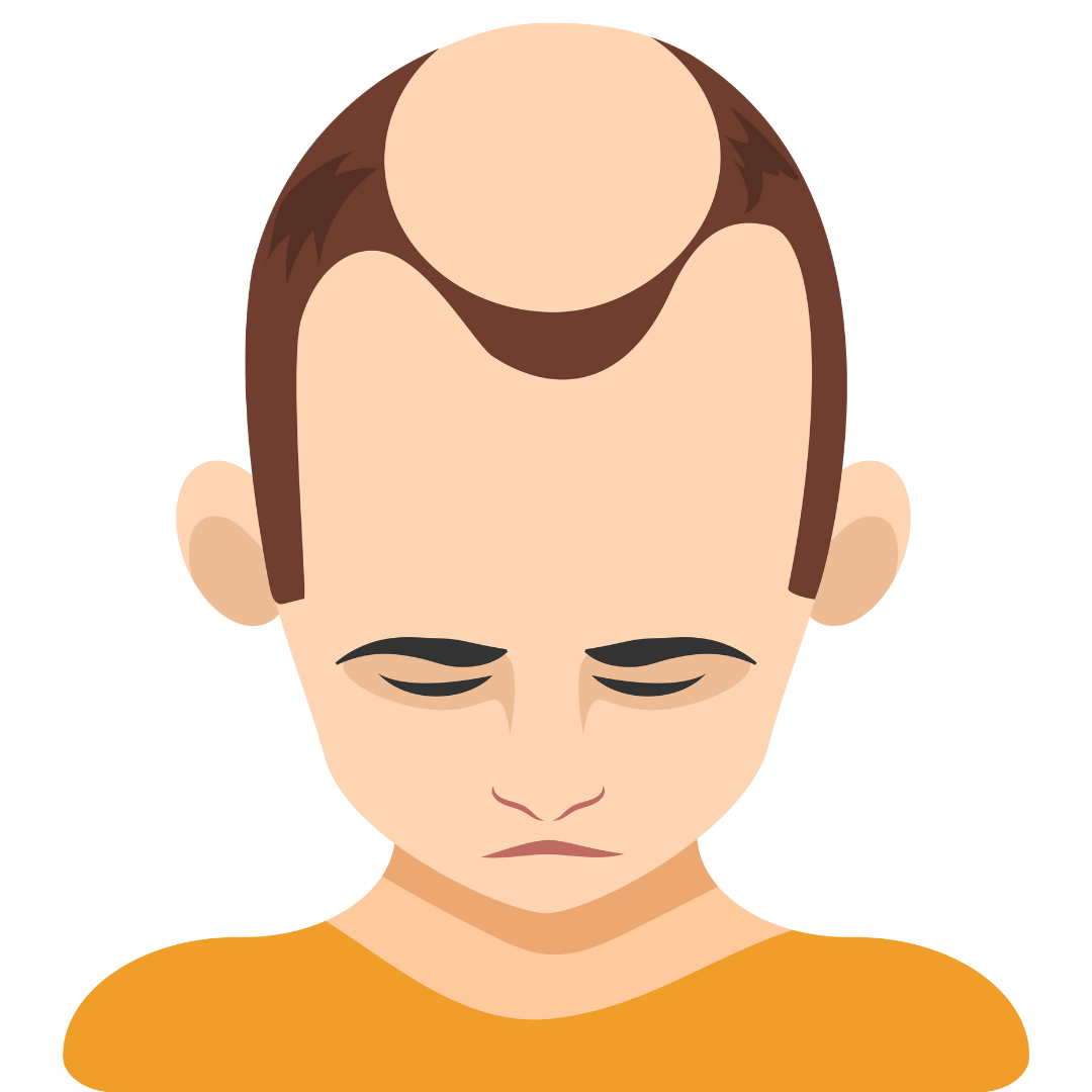 HAIR LOSS - Causes, Symptoms & Treatments with  Herbal |  Ayurvedic | Supplements