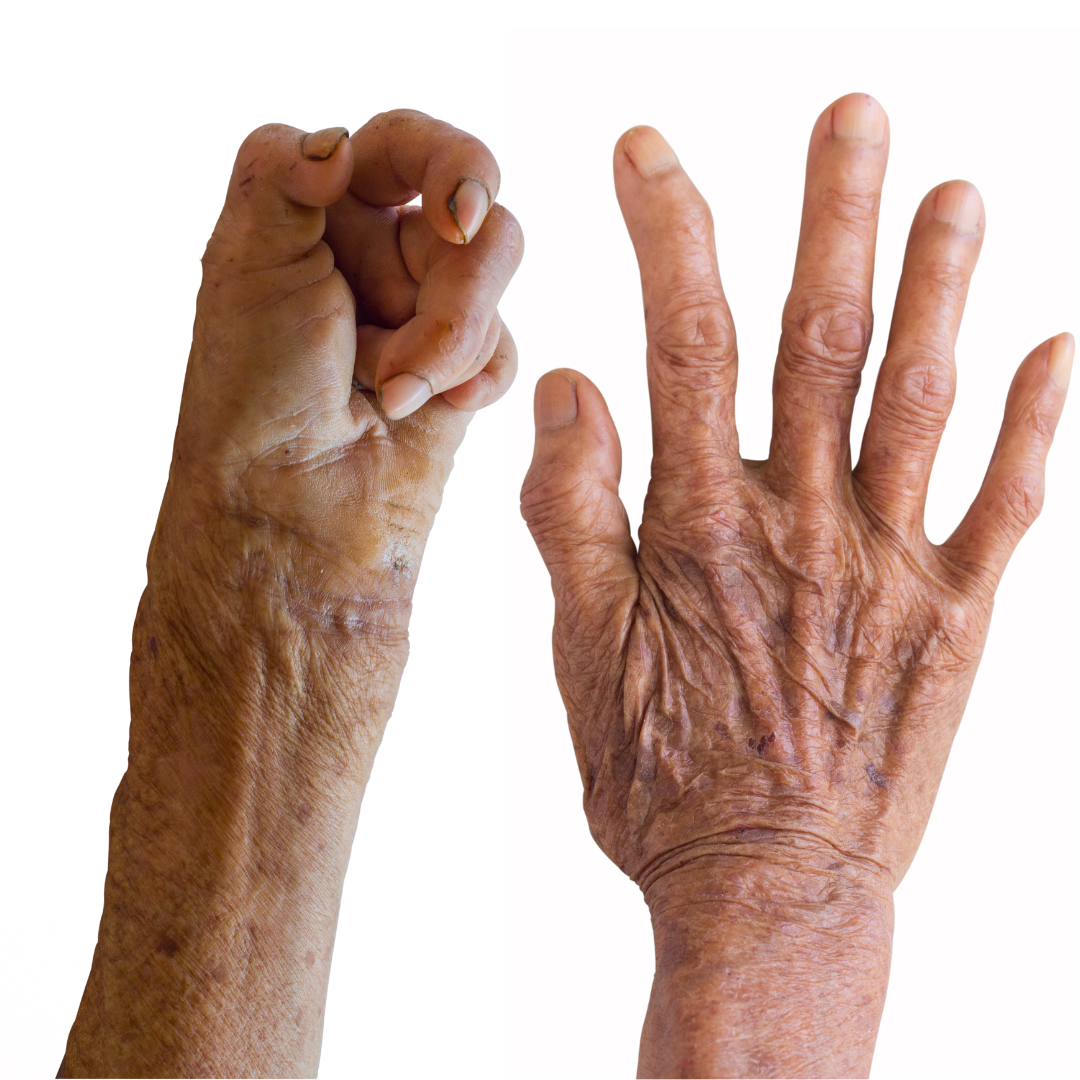 Leprosy is a chronic and progressive bacterial infection