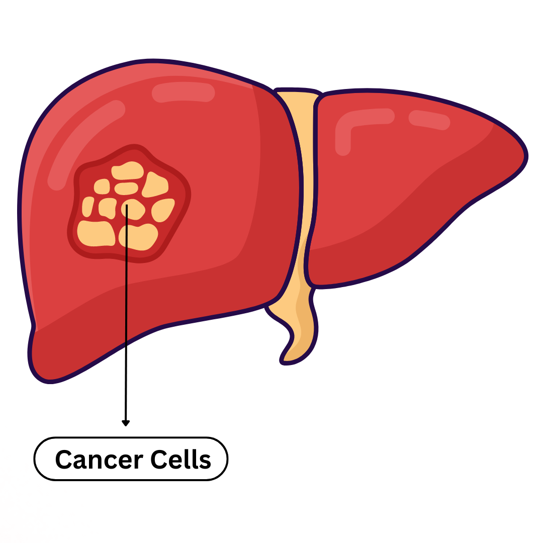 Liver Cancer Causes and Treatment