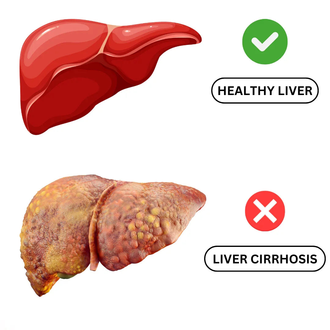 Liver Cirrhosis Causes and Treatment