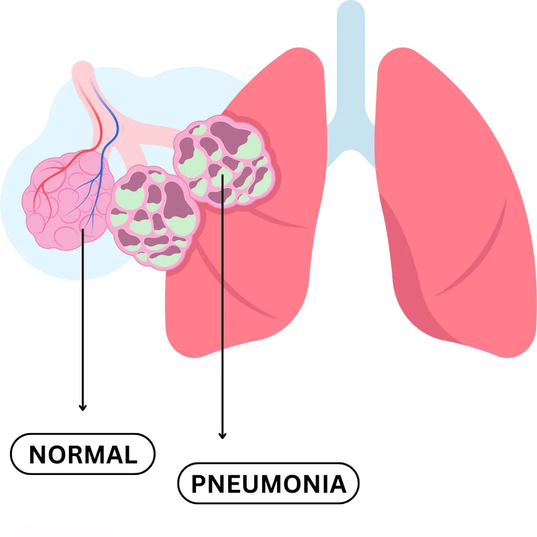 PNEUMONIA - Causes, Symptoms & Treatments with  Herbal |  Ayurvedic | Supplements