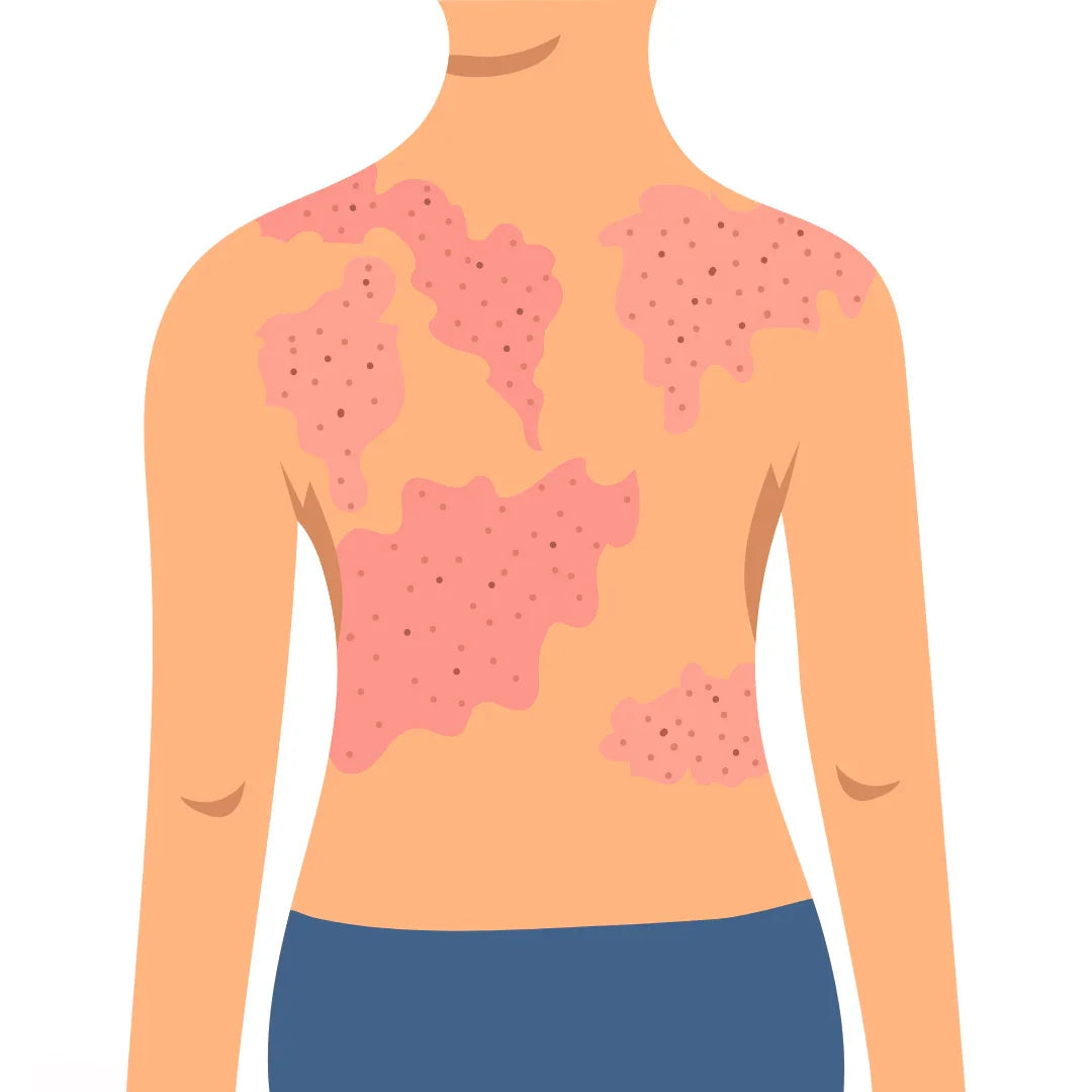 NATURAL Treatment for Psoriasis