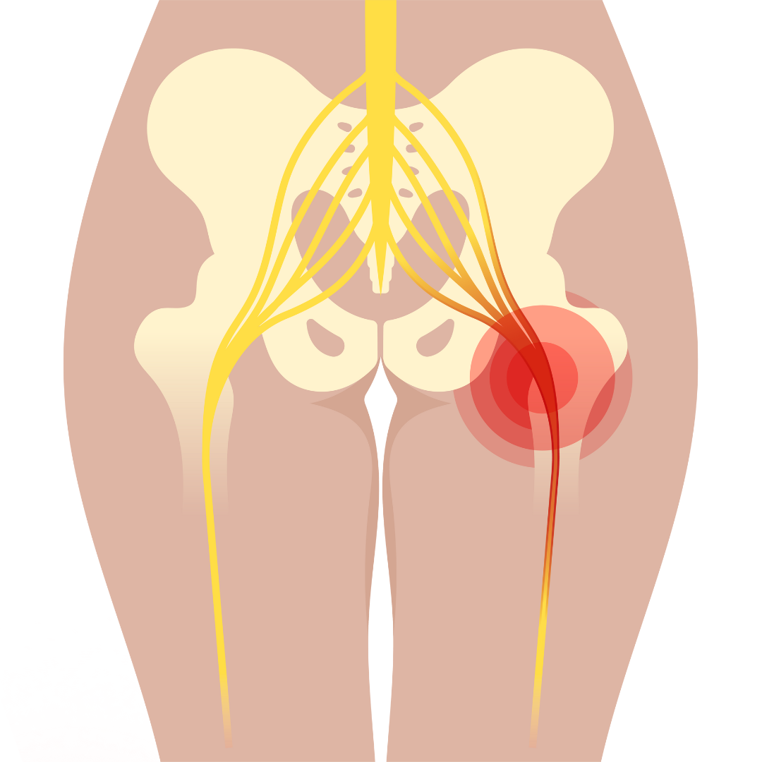 SCIATICA - Causes, Symptoms & Treatments with  Herbal |  Ayurvedic | Supplements