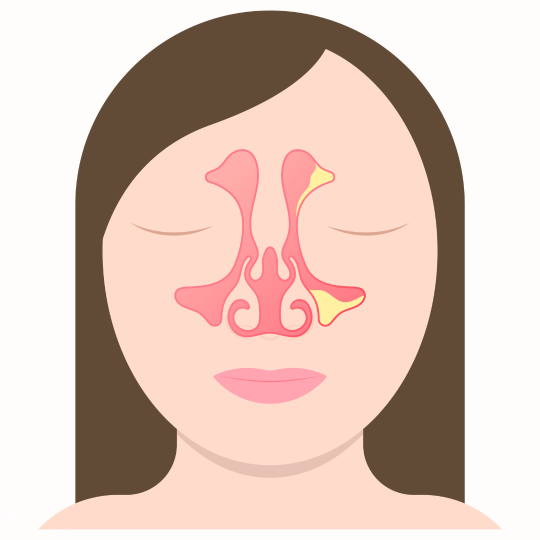 SINUS - Causes, Symptoms & Treatments with  Herbal |  Ayurvedic | Supplements