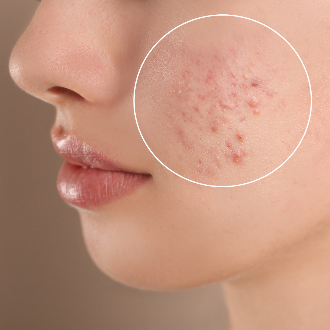 Acne & Pimples : Causes, Symptoms & Treatments with  Herbal |  Ayurvedic | Supplements